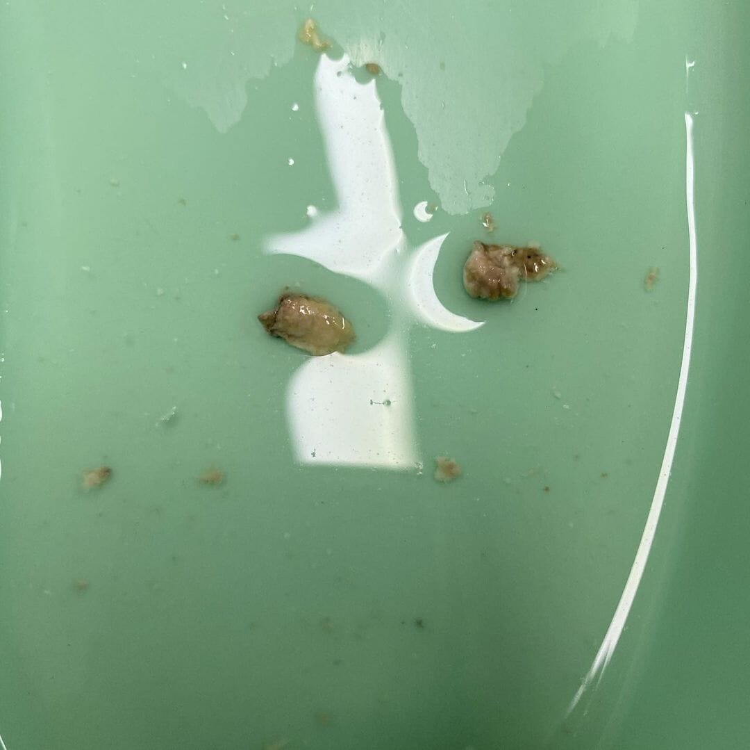 Doctors have struggled removing the bugs, which have laid eggs, with Jess suffering hearing loss